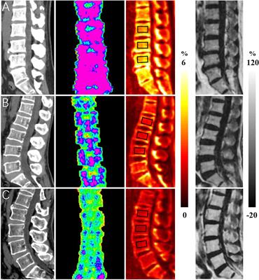 Assessment of Osteoporosis in Lumbar Spine: In Vivo Quantitative MR Imaging of Collagen Bound Water in Trabecular Bone